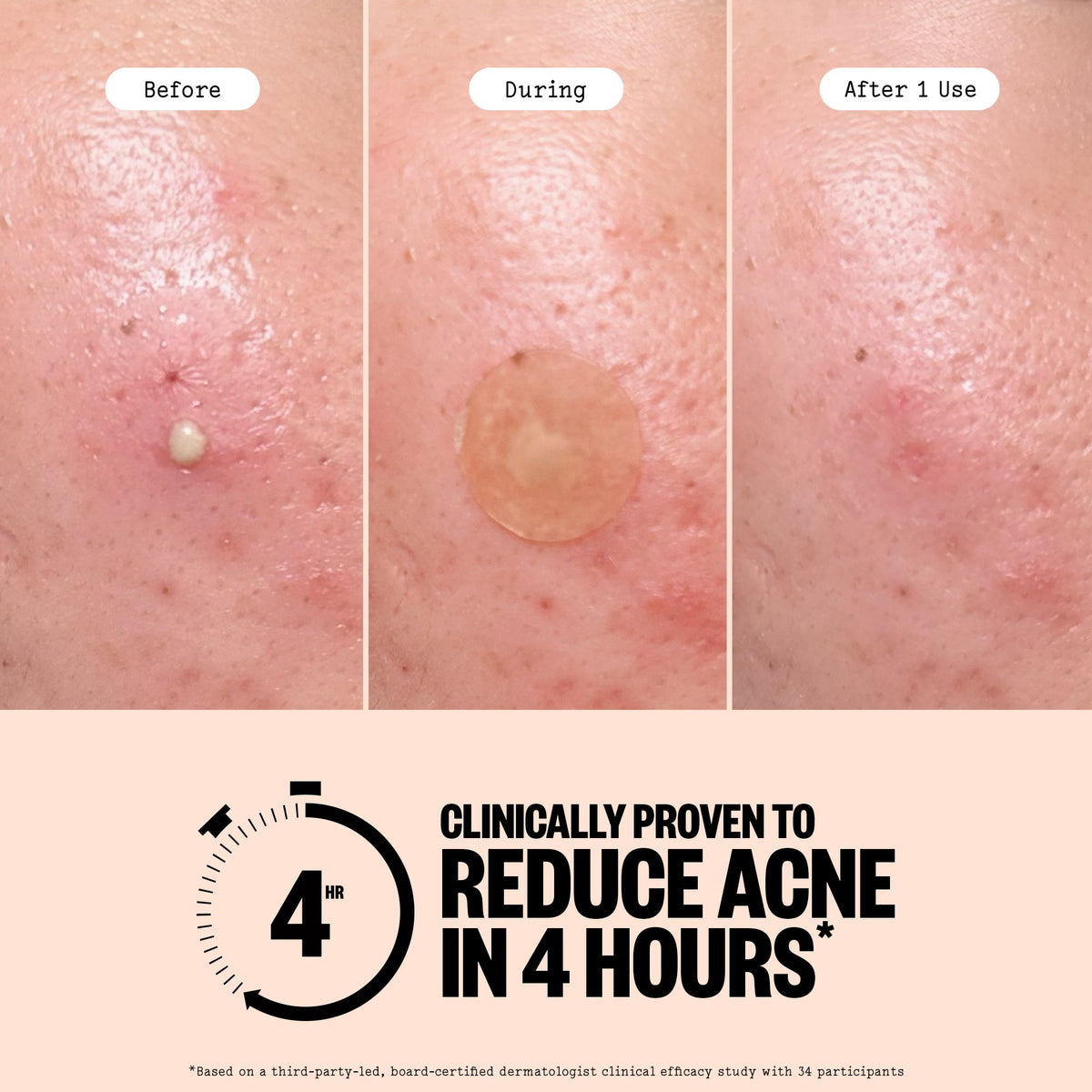 Acne Treatment 20 Dots